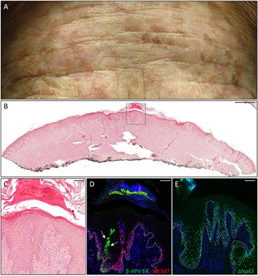 β-HPV Infection Correlates with Early Stages of Carcinogenesis in Skin Tumors and Patient-Derived Xenografts from a Kidney Transplant Recipient Cohort